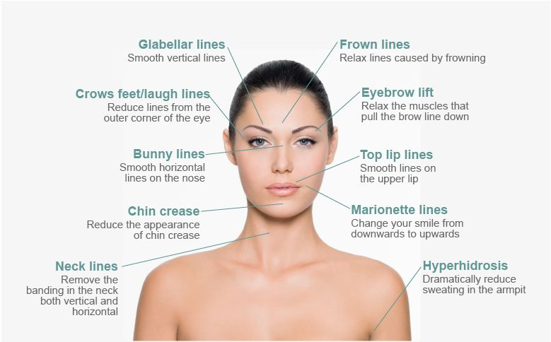 Diagram of treatment areas: glabellar lines, frown lines, crow's feet, eyebrow lift, bunny lines, top lip lines, chin crease, marionette lines, neck lines and hyperhidrosis